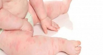 Bé bị nổi mề đay khắp người - Cách chữa nổi mề đay ở trẻ nhỏ